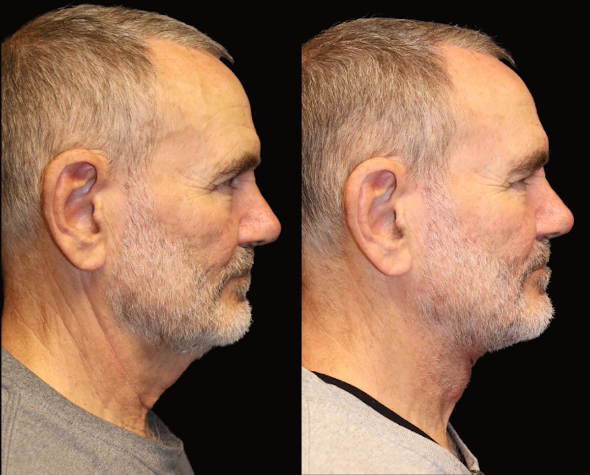 Neck Lift Before & After Gallery - Patient 177905846 - Image 1