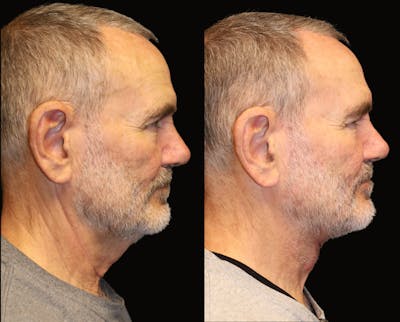 Neck Lift Before & After Gallery - Patient 177905846 - Image 1