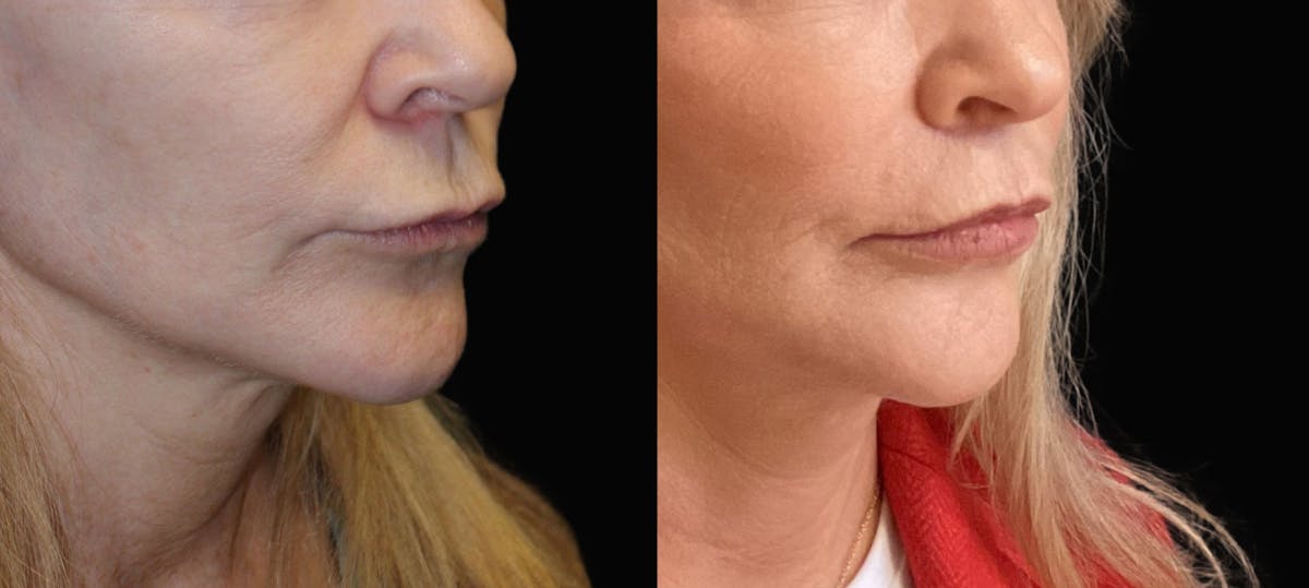 Lip Lift Before & After Gallery - Patient 177905330 - Image 2