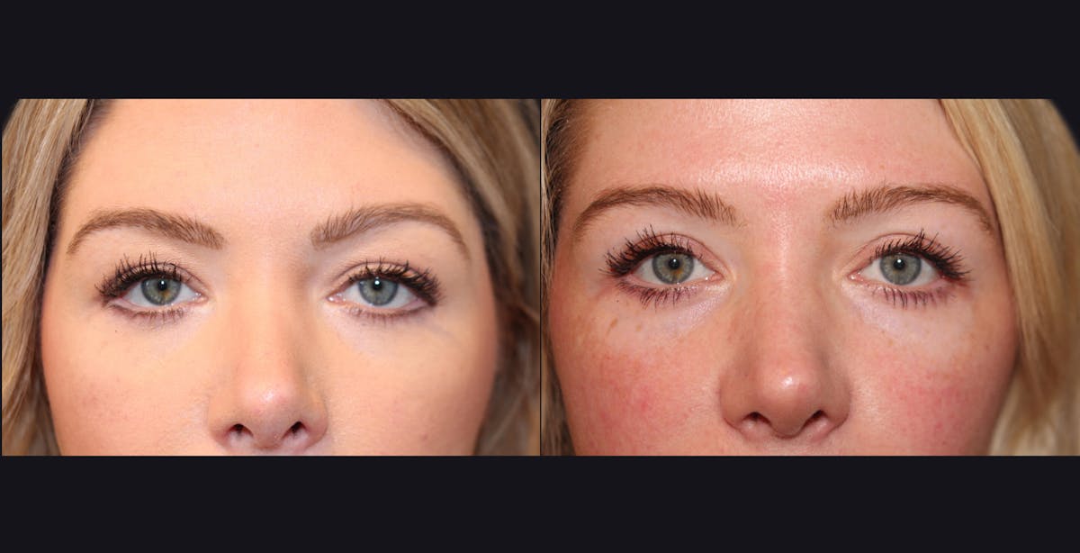 Blepharoplasty Before & After Gallery - Patient 128974 - Image 1