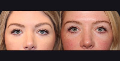 Blepharoplasty Before & After Gallery - Patient 128974 - Image 1