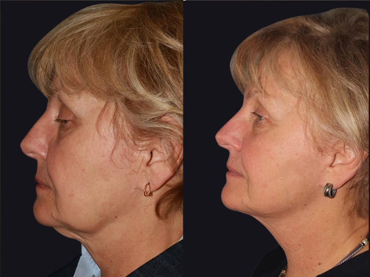 Facelift Before & After Gallery - Patient 849453 - Image 1