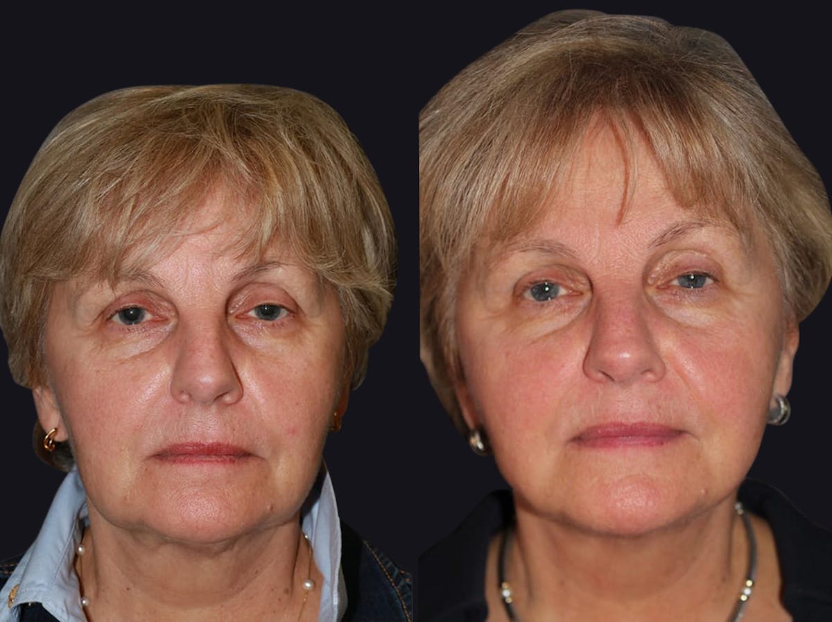 Facelift Before & After Gallery - Patient 849453 - Image 1