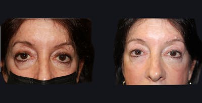 Blepharoplasty Before & After Gallery - Patient 406211 - Image 1