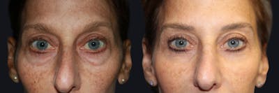 Blepharoplasty Before & After Gallery - Patient 155271 - Image 1