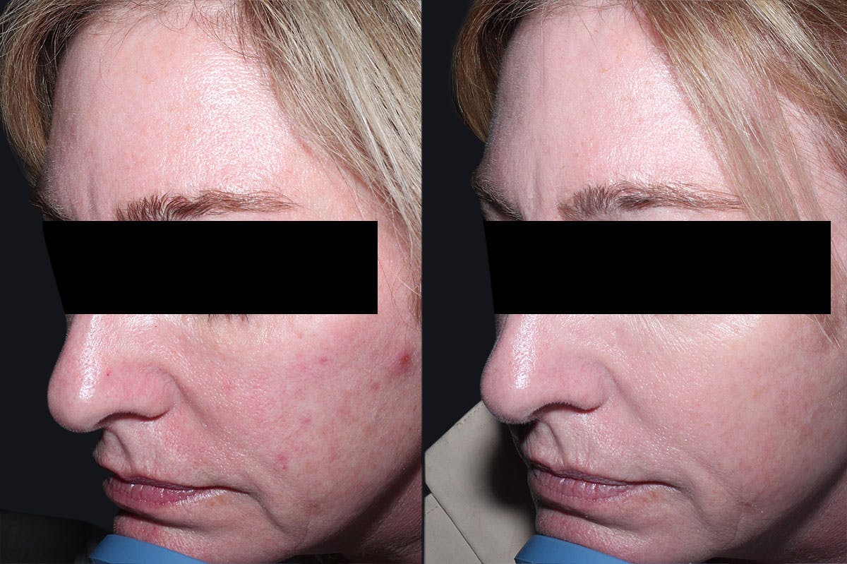 Skin Product Rejuvenation Before & After Gallery - Patient 486376 - Image 2