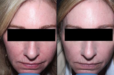 Skin Product Rejuvenation Before & After Gallery - Patient 486376 - Image 1