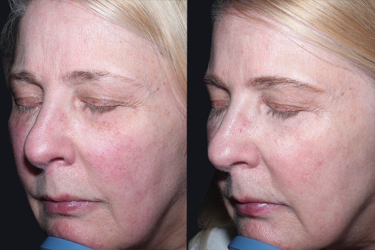 Skin Product Rejuvenation Before & After Gallery - Patient 116768 - Image 1