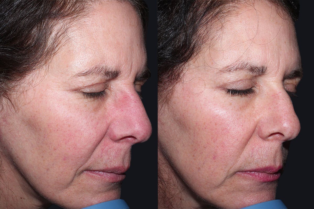 Skin Product Rejuvenation Before & After Gallery - Patient 207850 - Image 2