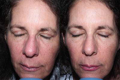 Skin Product Rejuvenation Before & After Gallery - Patient 207850 - Image 1