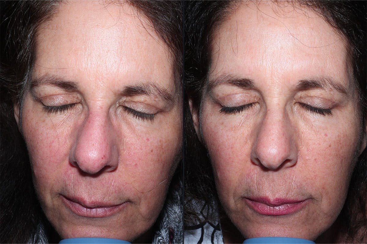 Skin Product Rejuvenation Before & After Gallery - Patient 207850 - Image 1