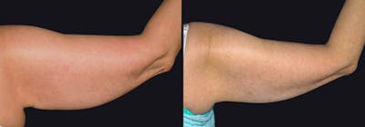Skin Tightening Before & After Gallery - Patient 177929028 - Image 1