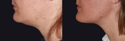 Skin Tightening Before & After Gallery - Patient 177929026 - Image 1