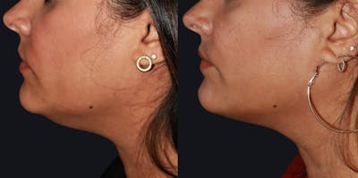 Skin Tightening Before & After Gallery - Patient 177929025 - Image 1