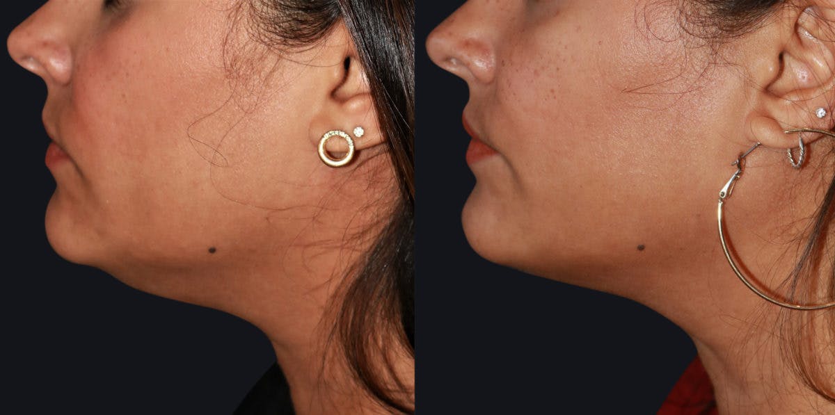 Skin Tightening Before & After Gallery - Patient 177929025 - Image 1