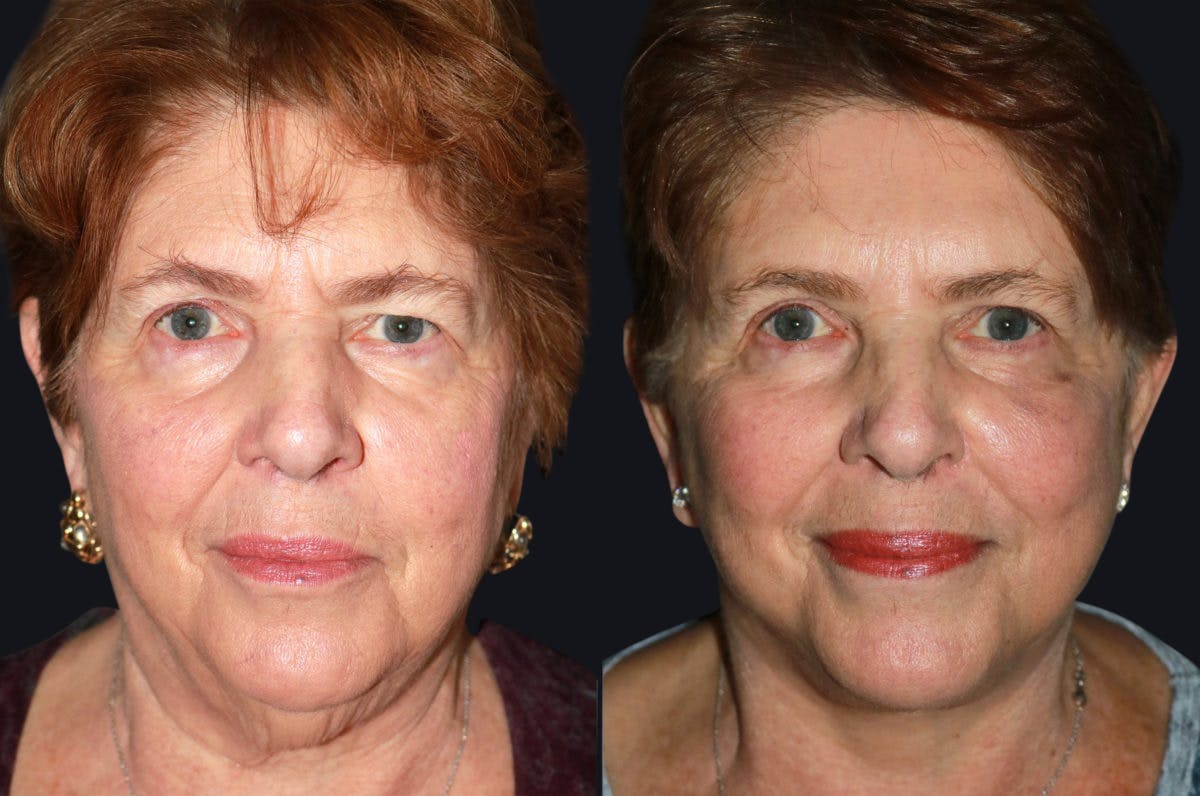 Facelift Before & After Gallery - Patient 177928994 - Image 1