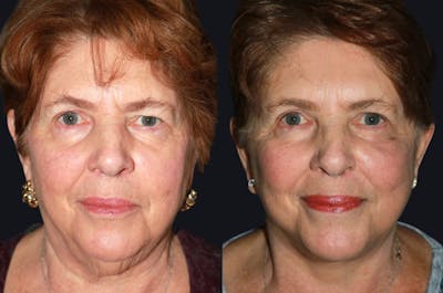 Facelift Before & After Gallery - Patient 177928994 - Image 1