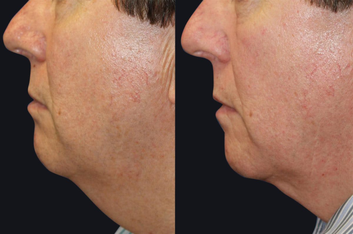 Skin Tightening Before & After Gallery - Patient 177928992 - Image 1