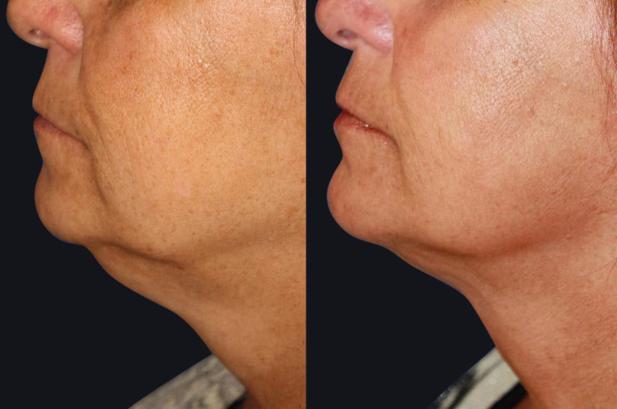 Skin Tightening Before & After Gallery - Patient 177928965 - Image 1