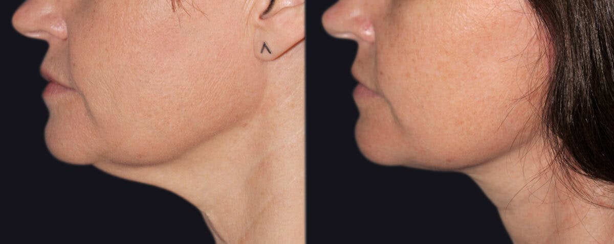 Facelift Before & After Gallery - Patient 177928964 - Image 1