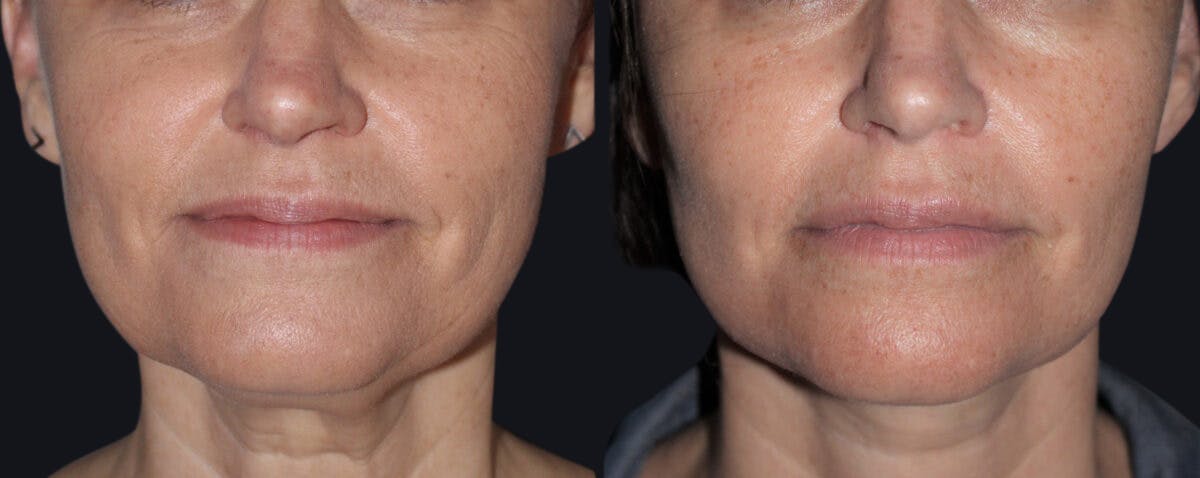 Facelift Before & After Gallery - Patient 177928964 - Image 2