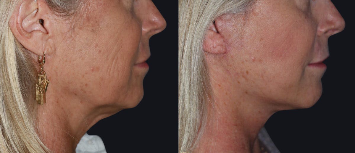 Facelift Before & After Gallery - Patient 177928920 - Image 1