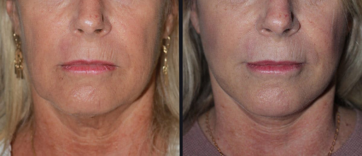 Facelift Before & After Gallery - Patient 177928920 - Image 2
