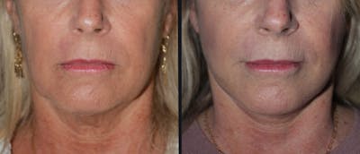 Facelift Before & After Gallery - Patient 177928920 - Image 1