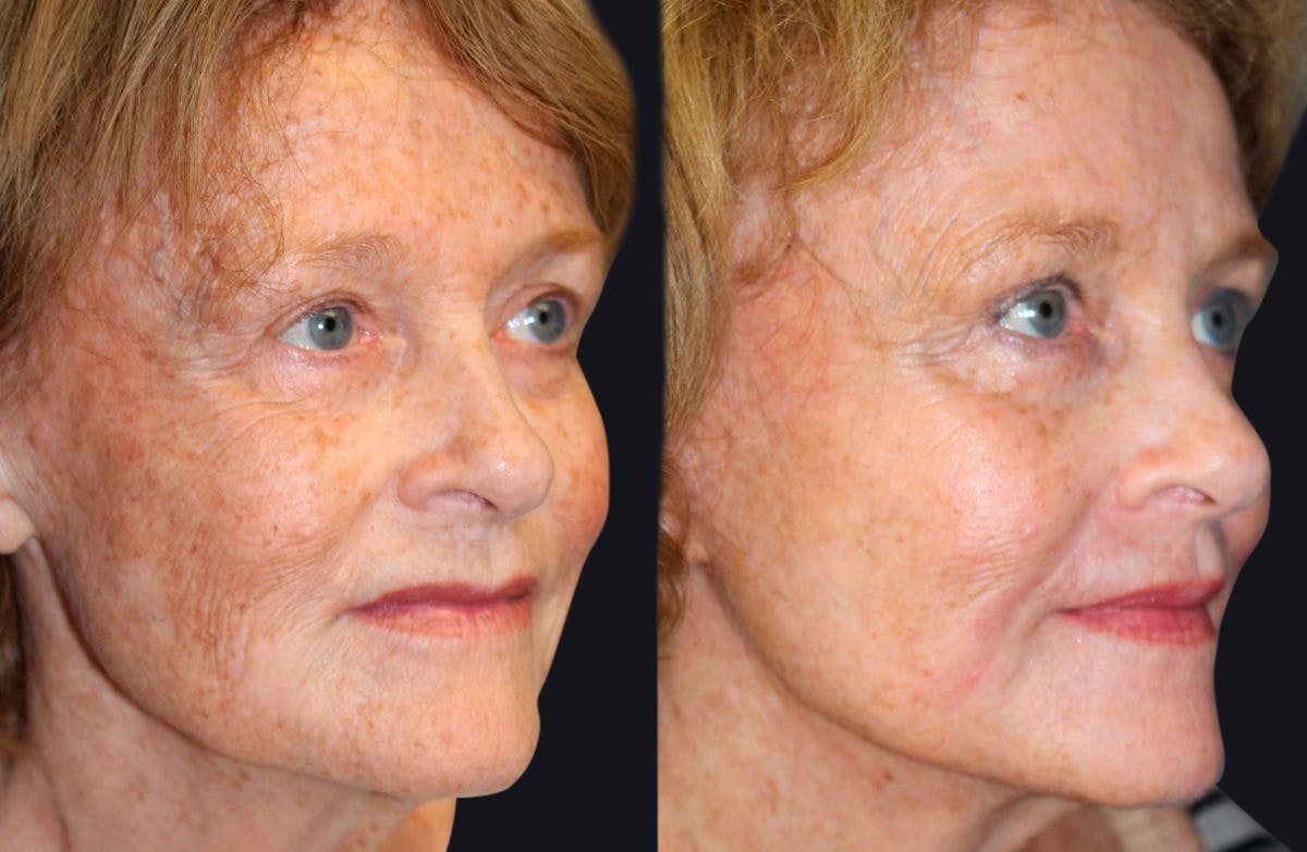 Laser Skin Rejuvenation Before & After Gallery - Patient 177928867 - Image 1
