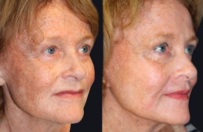 Laser Skin Rejuvenation Before & After Gallery - Patient 177928867 - Image 1