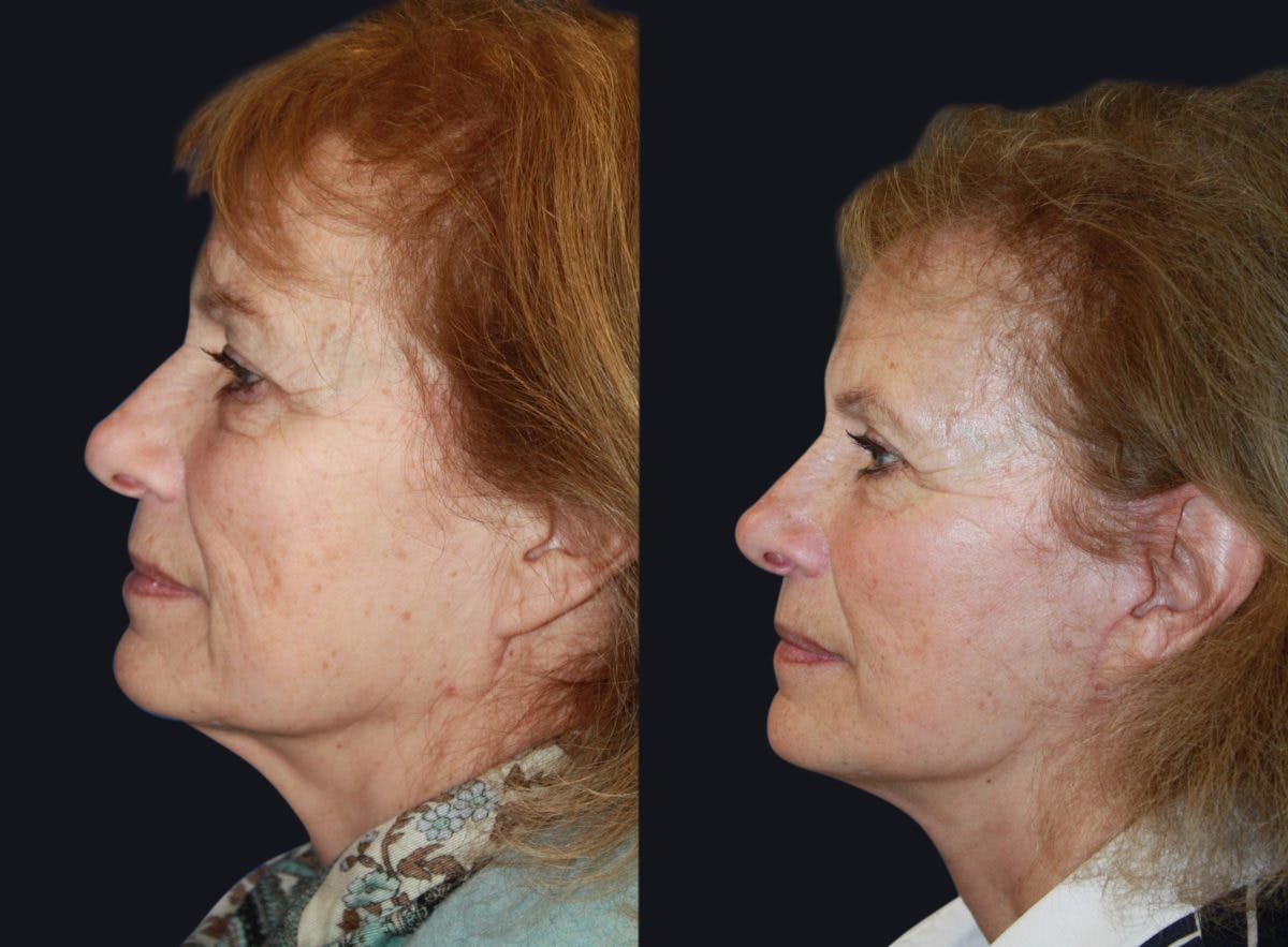 Facelift Before & After Gallery - Patient 177928824 - Image 1