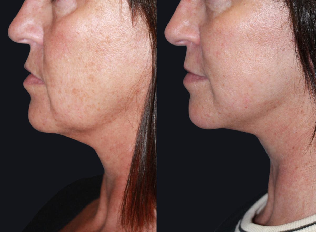 Laser Skin Rejuvenation Before & After Gallery - Patient 177928801 - Image 1