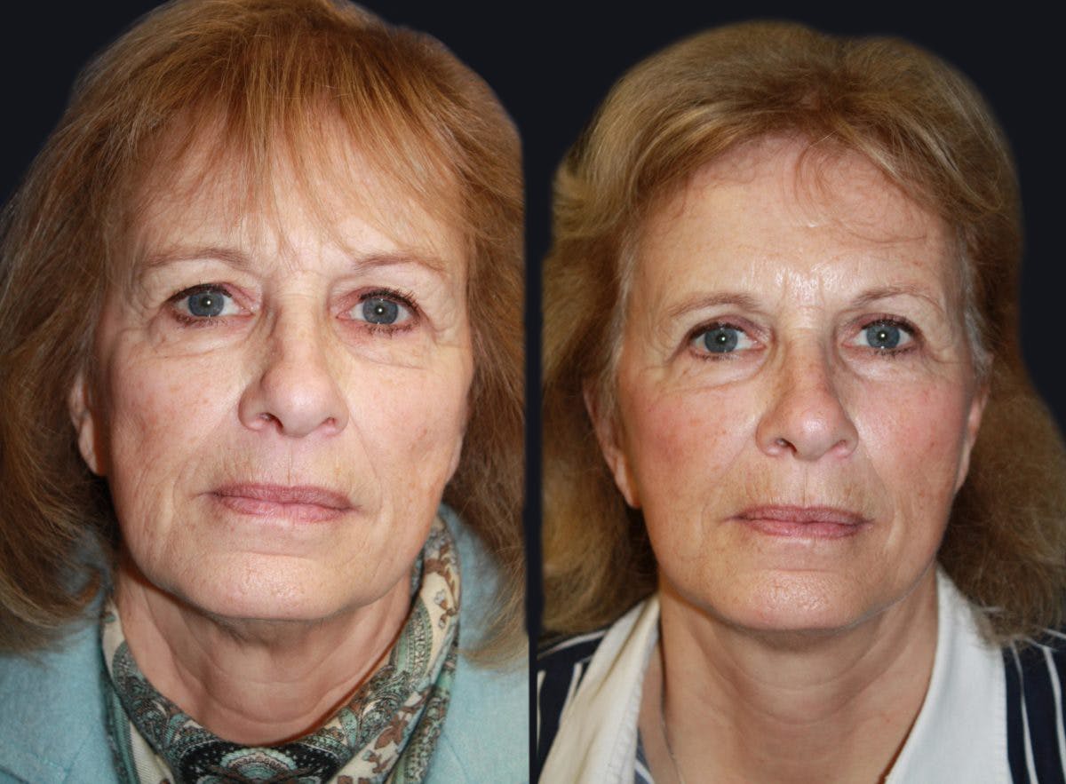 Facelift Before & After Gallery - Patient 177928824 - Image 2