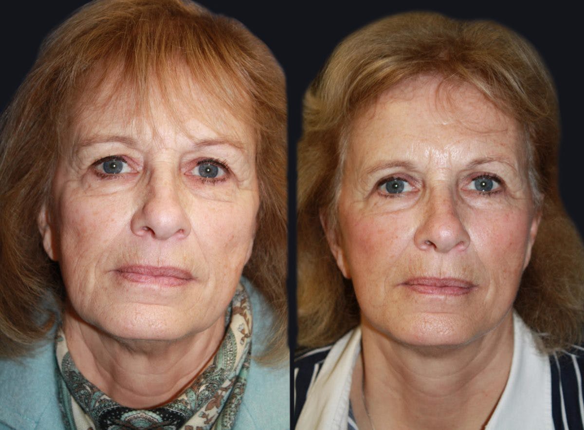 Facelift Before & After Gallery - Patient 177928824 - Image 1
