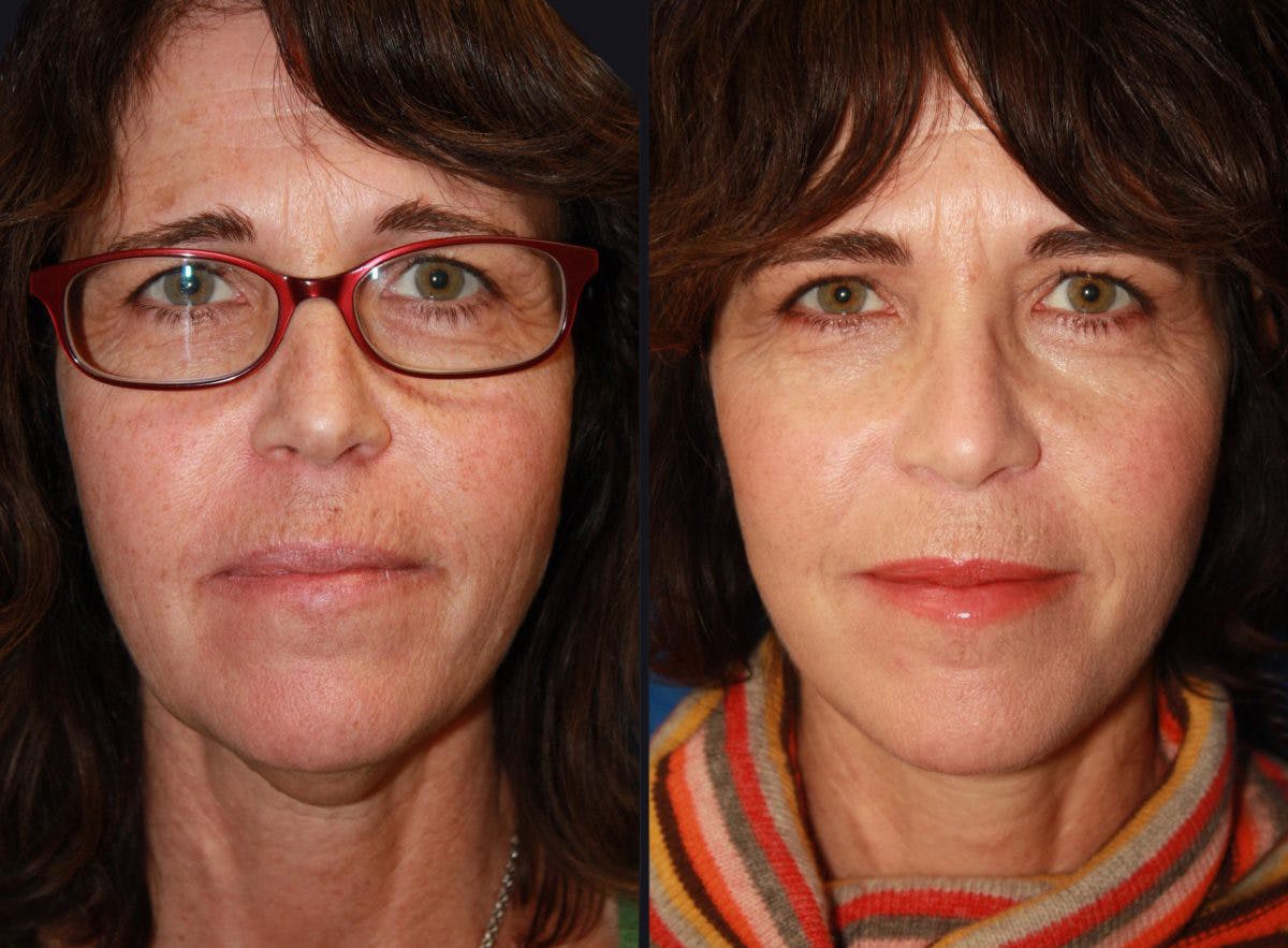 Facelift Before & After Gallery - Patient 177928681 - Image 2
