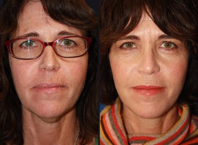 Facelift Before & After Gallery - Patient 177928681 - Image 1