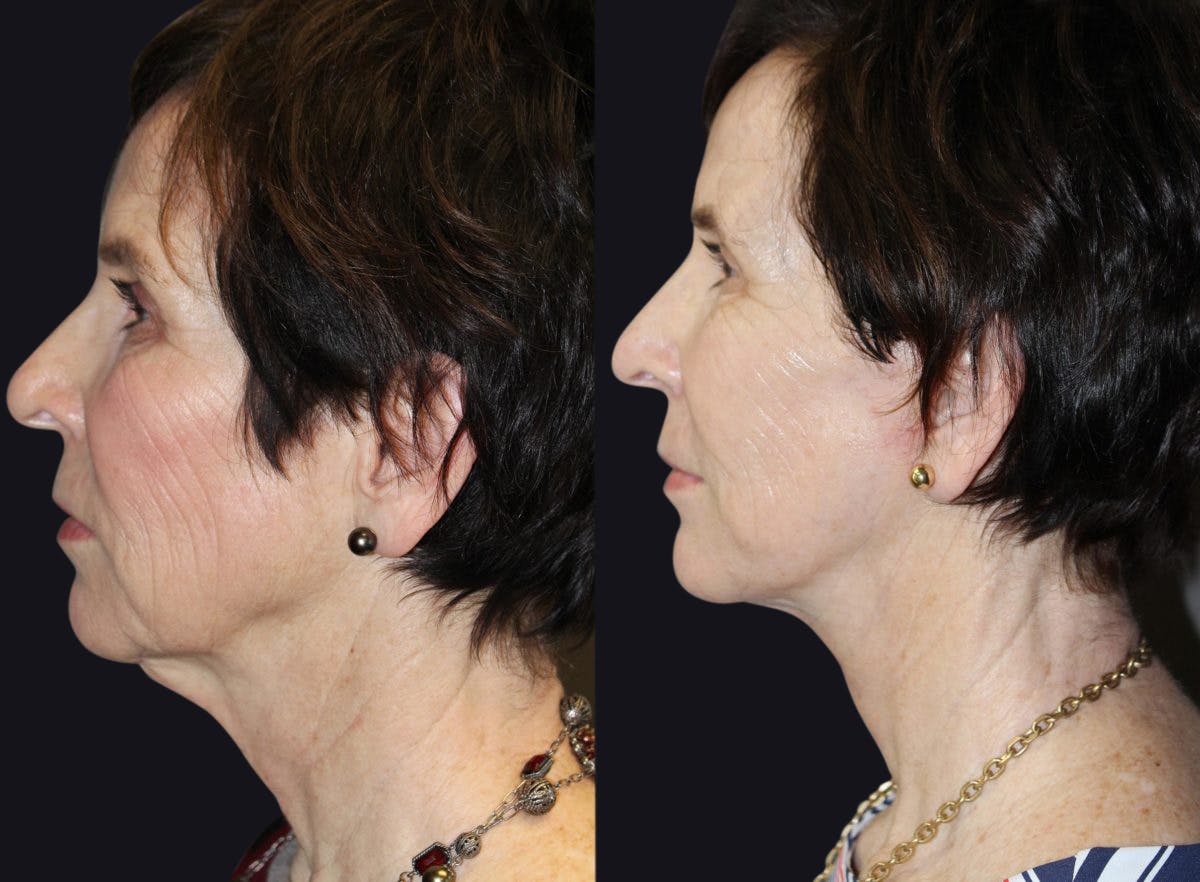 Facelift Before & After Gallery - Patient 177928556 - Image 1