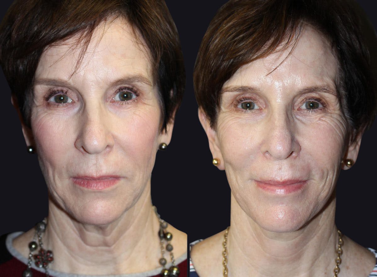 Facelift Before & After Gallery - Patient 177928556 - Image 2