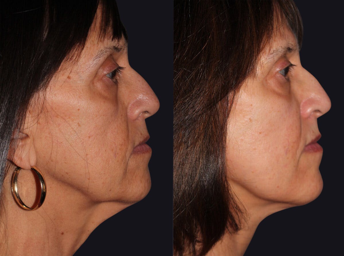 Facelift Before & After Gallery - Patient 177928469 - Image 1