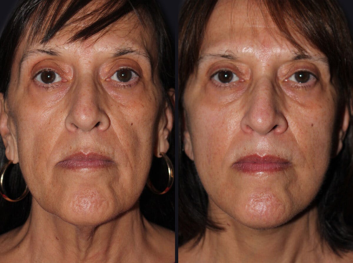 Facelift Before & After Gallery - Patient 177928469 - Image 2