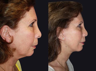 Facelift Before & After Gallery - Patient 177928468 - Image 1