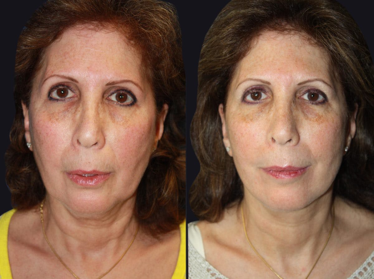 Facelift Before & After Gallery - Patient 177928468 - Image 1