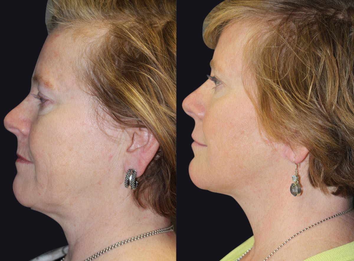 Facelift Before & After Gallery - Patient 177928466 - Image 1