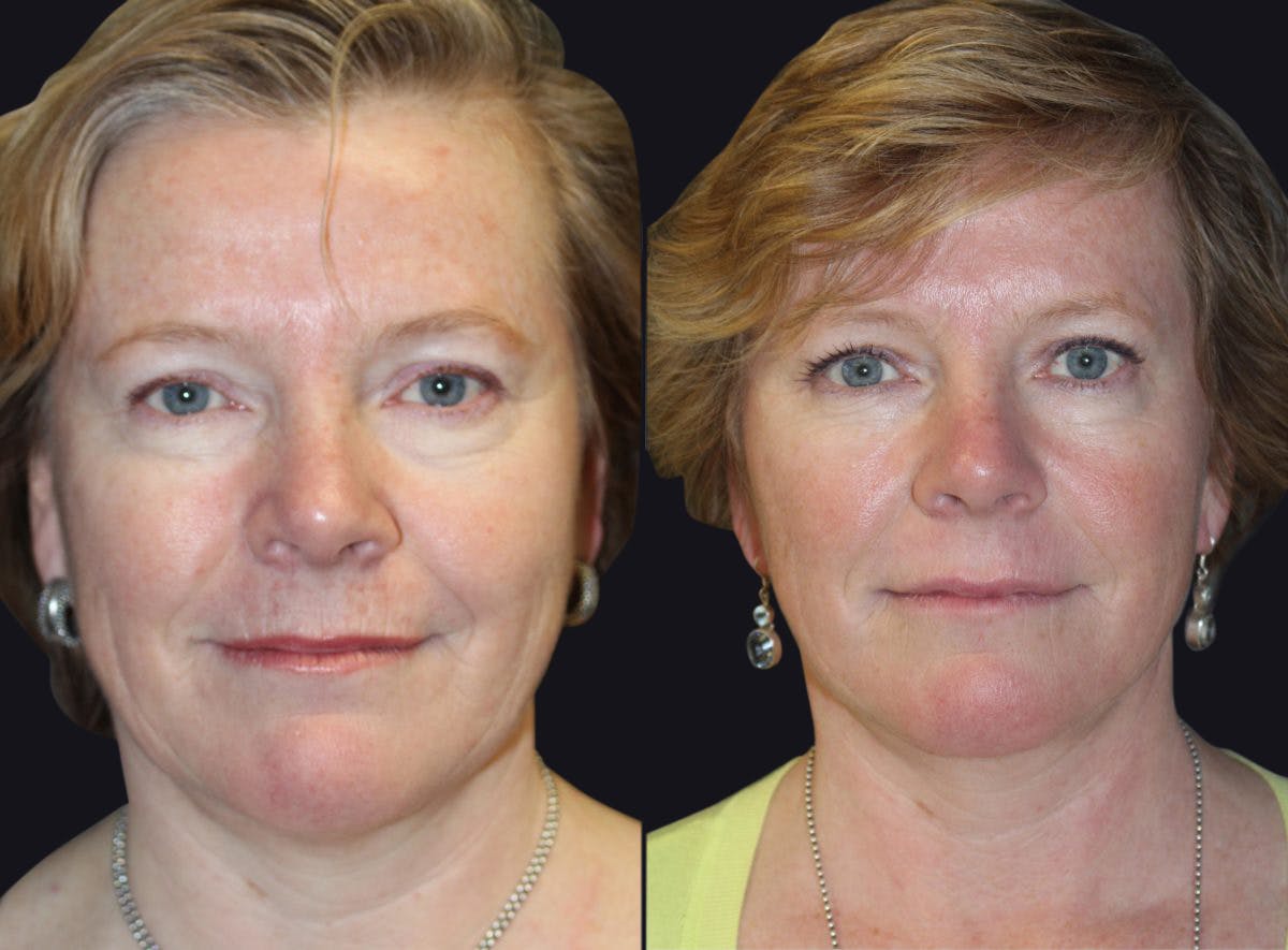 Facelift Before & After Gallery - Patient 177928466 - Image 2