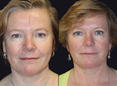 Facelift Before & After Gallery - Patient 177928466 - Image 1