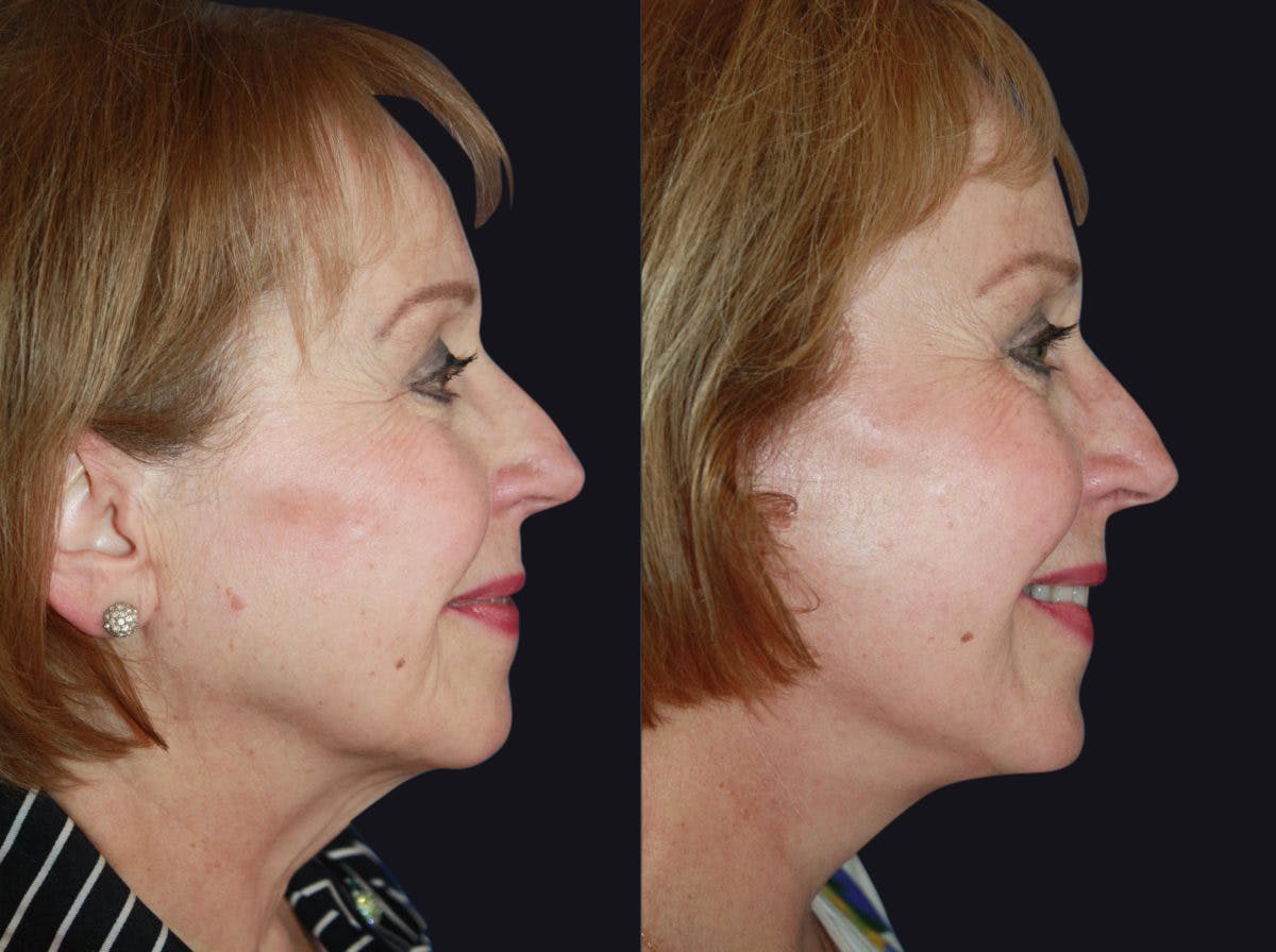 Facelift Before & After Gallery - Patient 177928464 - Image 1