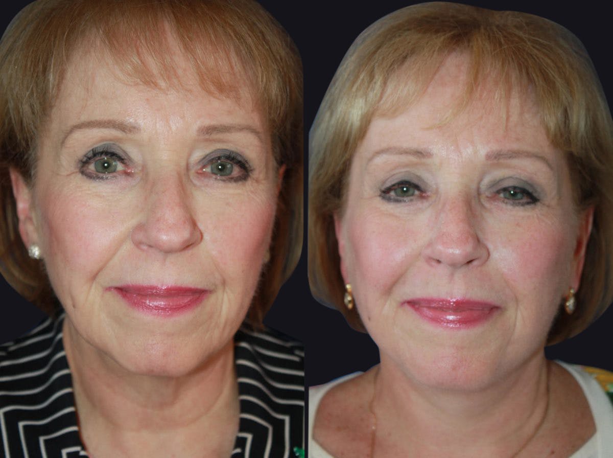 Facelift Before & After Gallery - Patient 177928464 - Image 2