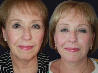 Facelift Before & After Gallery - Patient 177928464 - Image 1