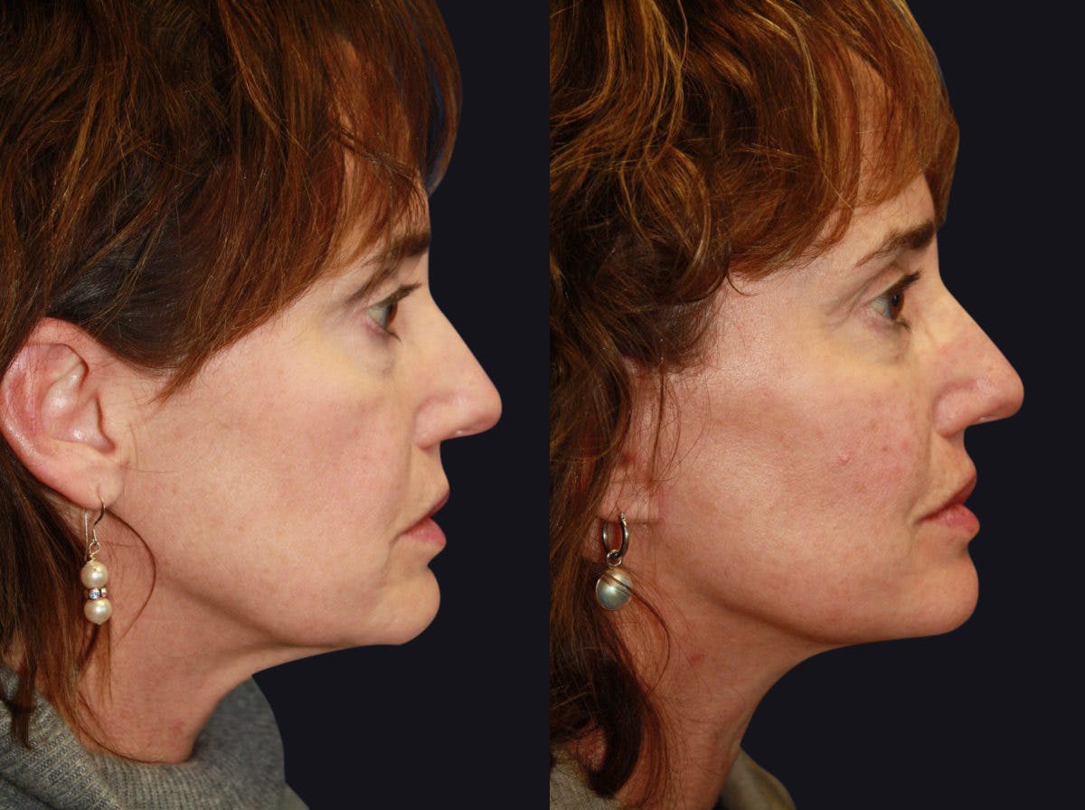 Facelift Before & After Gallery - Patient 177928461 - Image 1
