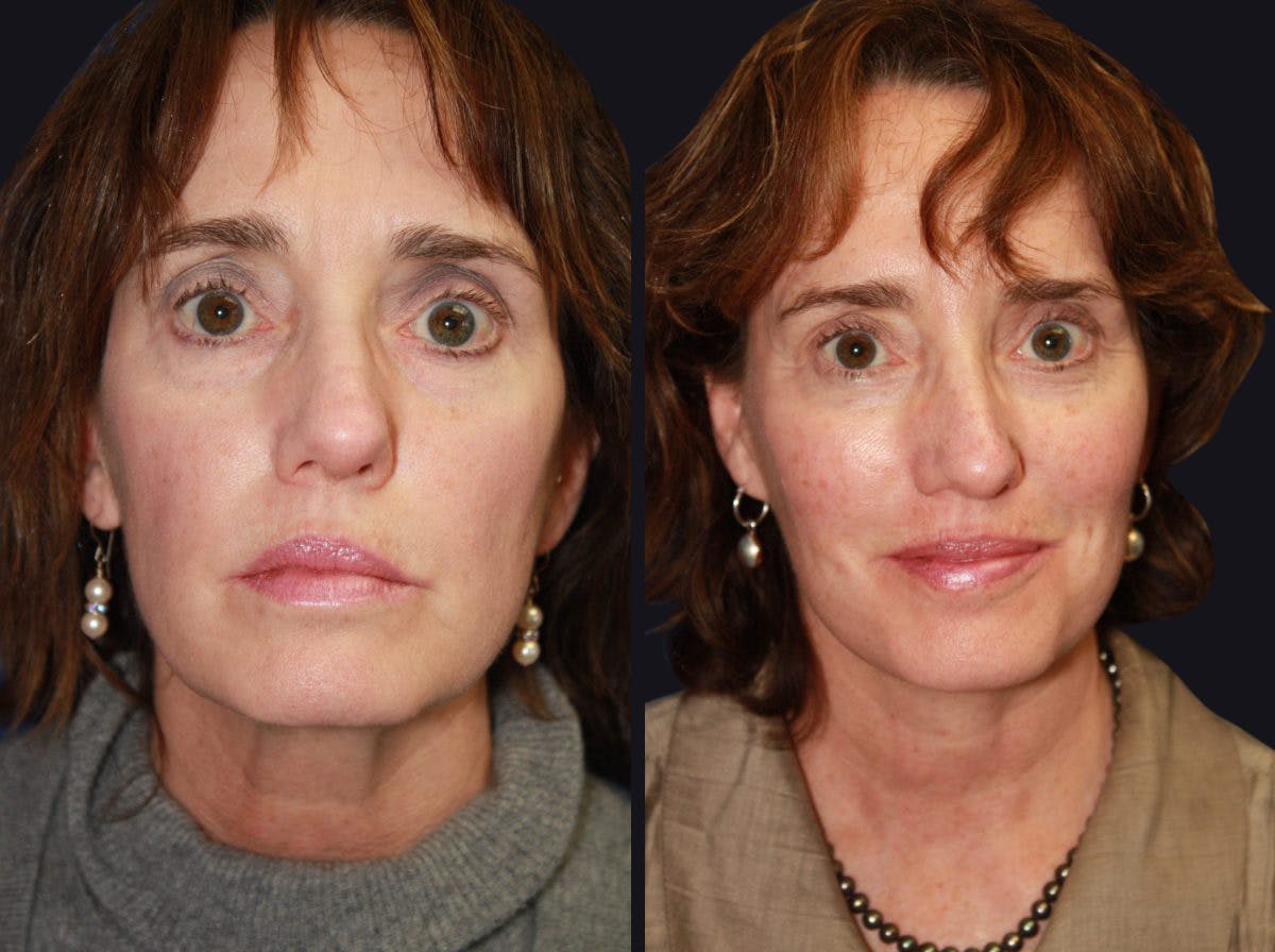 Facelift Before & After Gallery - Patient 177928461 - Image 2